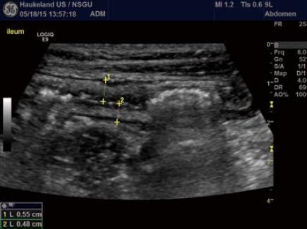 measurement of small intestine thickness|Gastrointestinal wall thickness measured with transabdominal .